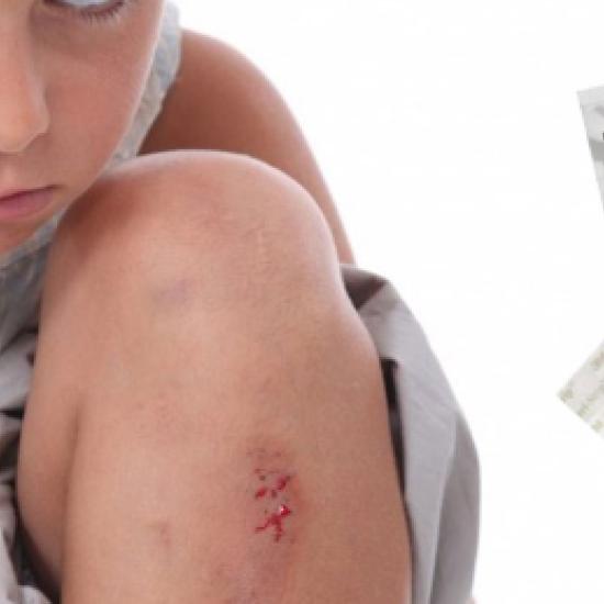 Comment poser un steri-strip ?