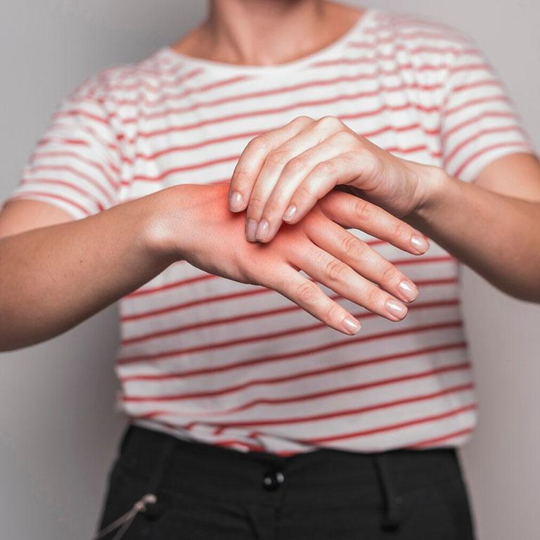 Brûlure chimique que faire