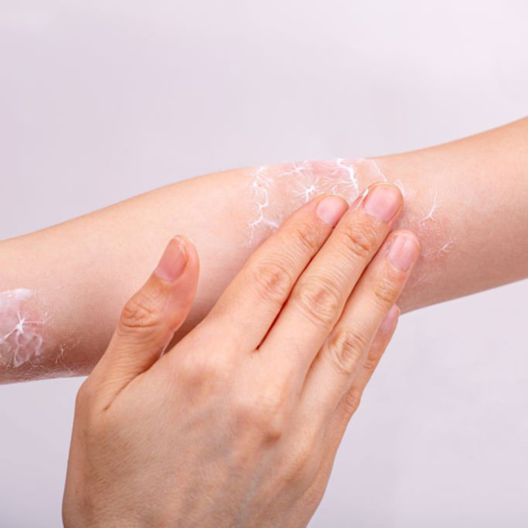 Que faire en cas de brûlures thermiques ?