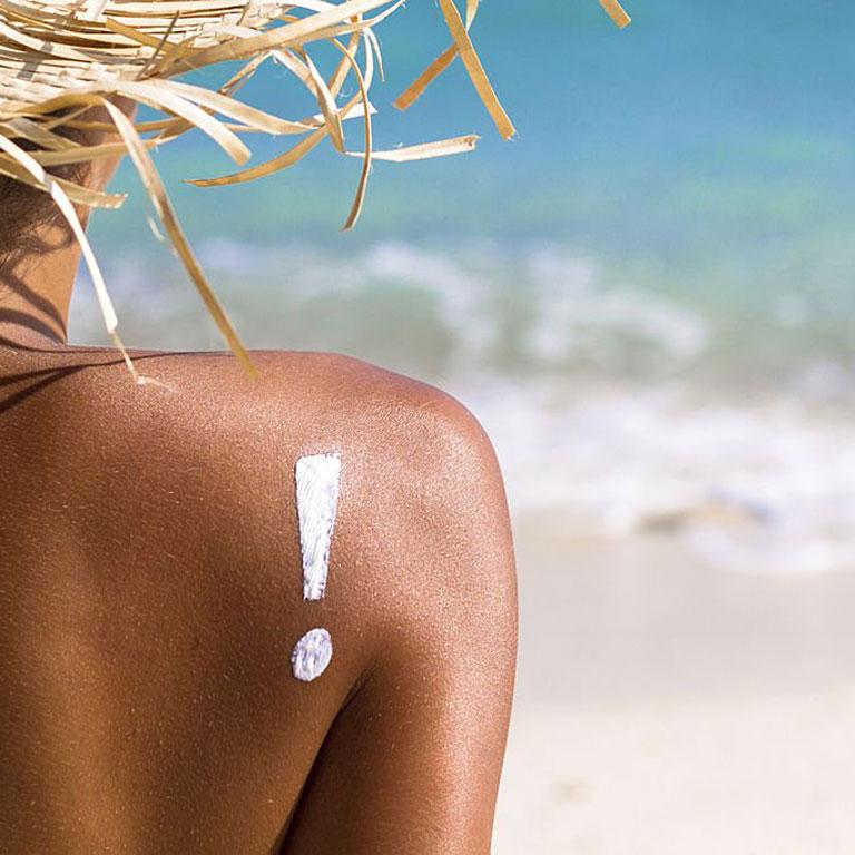 Que faire en cas de brûlure solaire ?