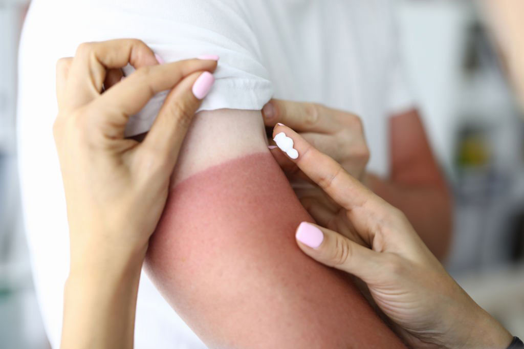 Traiter les coups de soleil